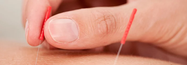 Dry-Needling-in-Sterling-VA Dry Needling in Sterling VA