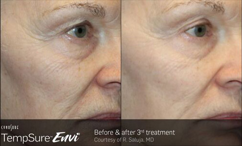 TempSure-Sterling-VA-Before-and-After TempSure Sterling VA Before and After