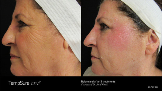 TempSure-Sterling-VA-Before-and-After TempSure Sterling VA Before and After